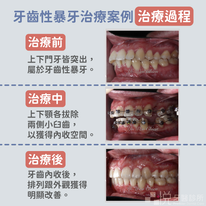 牙齒性暴牙治療案例