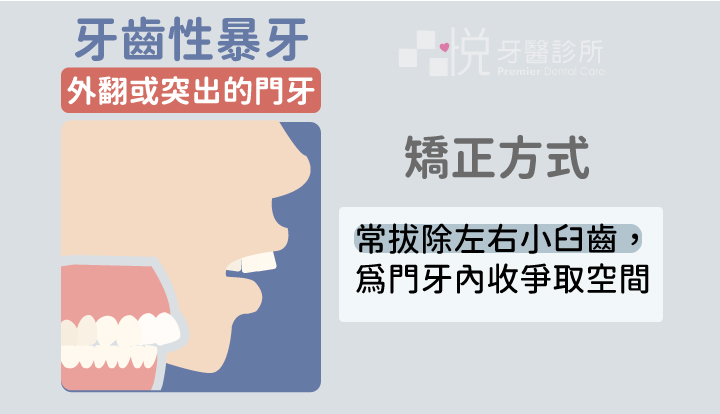 單純牙齒性暴牙常見的特徵為:外翻和向前突出的上顎門牙,或是上顎與下顎門牙皆為外翻和突出。
單純牙齒性暴牙的矯正方式,常採用拔除左側和右側各一顆小臼齒。利用拔牙所獲得的空間,讓前突的門牙得以往內收,改善暴牙的外觀。