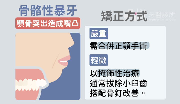 骨骼性暴牙則是常有下巴後縮或小下巴的側臉外觀,然而上顎門牙卻不一定會有外翻和突出的表現。
嚴重的骨骼性暴牙,無法只單純做牙齒矯正,仍需要合併正顎手術才能獲得理想的治療成果。
