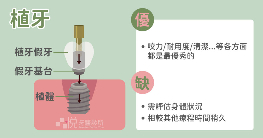 植牙:各方面(咬力、耐用度、清潔度、成功率)都是最優秀的缺電視療程時間稍微久。