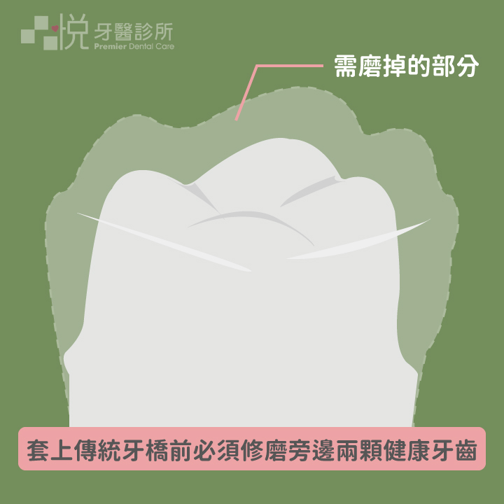 傳統牙橋必須修磨旁邊兩顆健康的牙齒