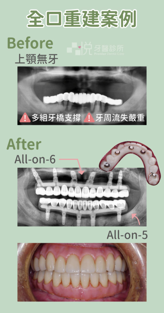 多顆缺牙常需合併多種治療方式,若是缺牙狀況嚴重也可評估使用 All-on-4 全口重建方式