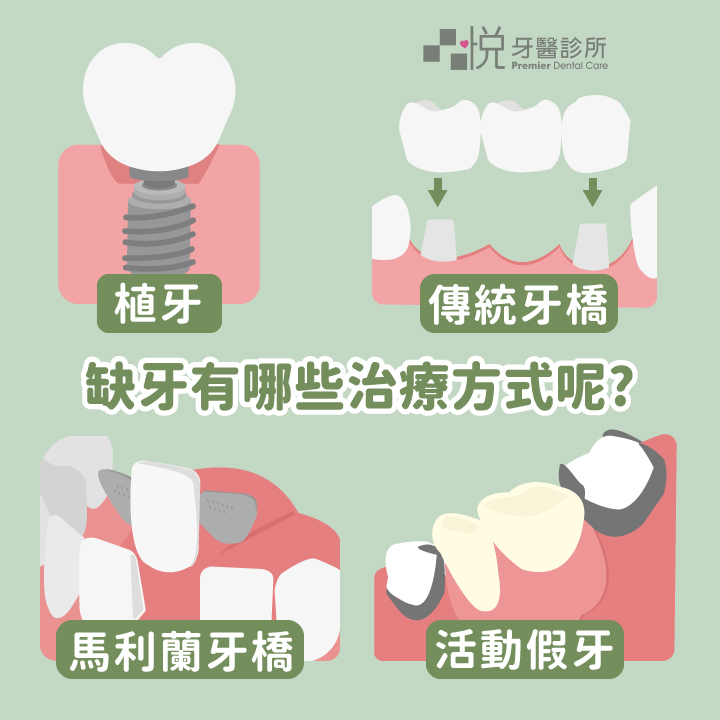 單顆缺牙方式通常有:植牙、傳統牙橋、馬利蘭牙橋、活動假牙