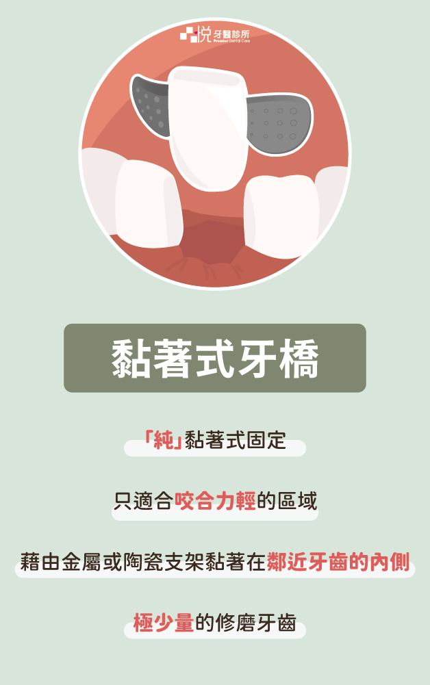 黏著式牙橋,亦稱「馬利蘭牙橋」。是純黏著式固定、只是用在咬合力輕的區域、黏在靠近牙齒的內側、極少量的修磨牙齒