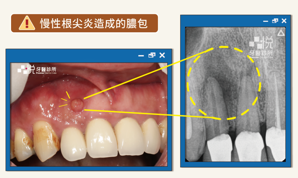 膿包案例照，慢性根尖炎引起的牙根尖膿包