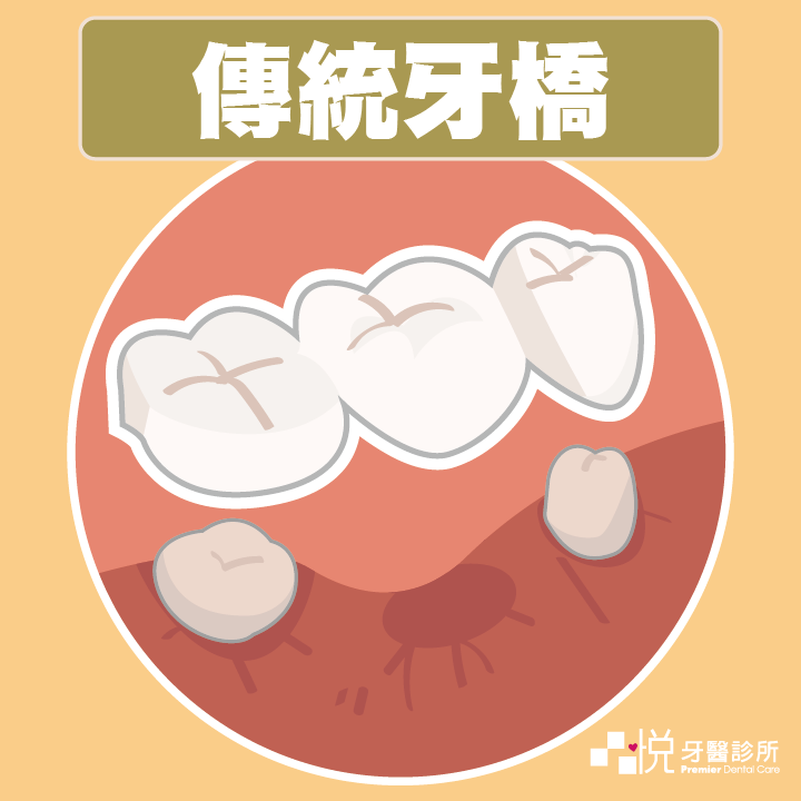 傳統牙橋示意圖