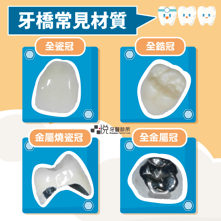 牙橋常見四大材質:全瓷冠、全鋯冠、金屬燒瓷冠以及全金屬冠。