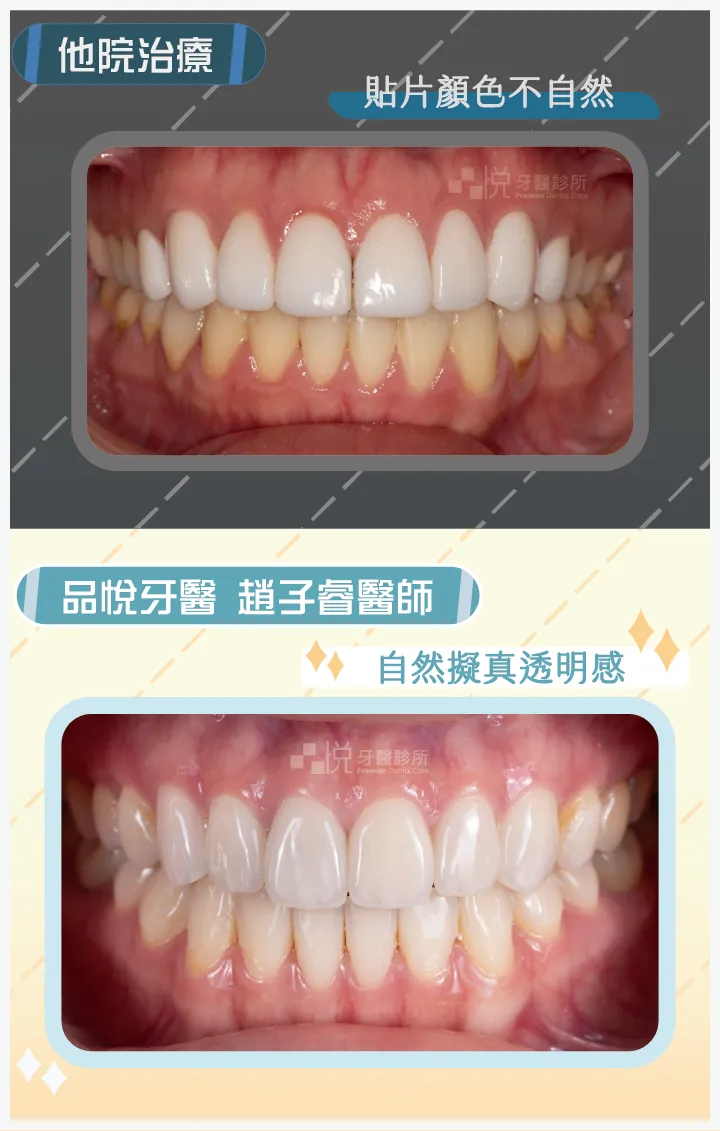品悅牙醫趙醫師製作之假牙成果,自然擬真且帶有真牙的透明感。