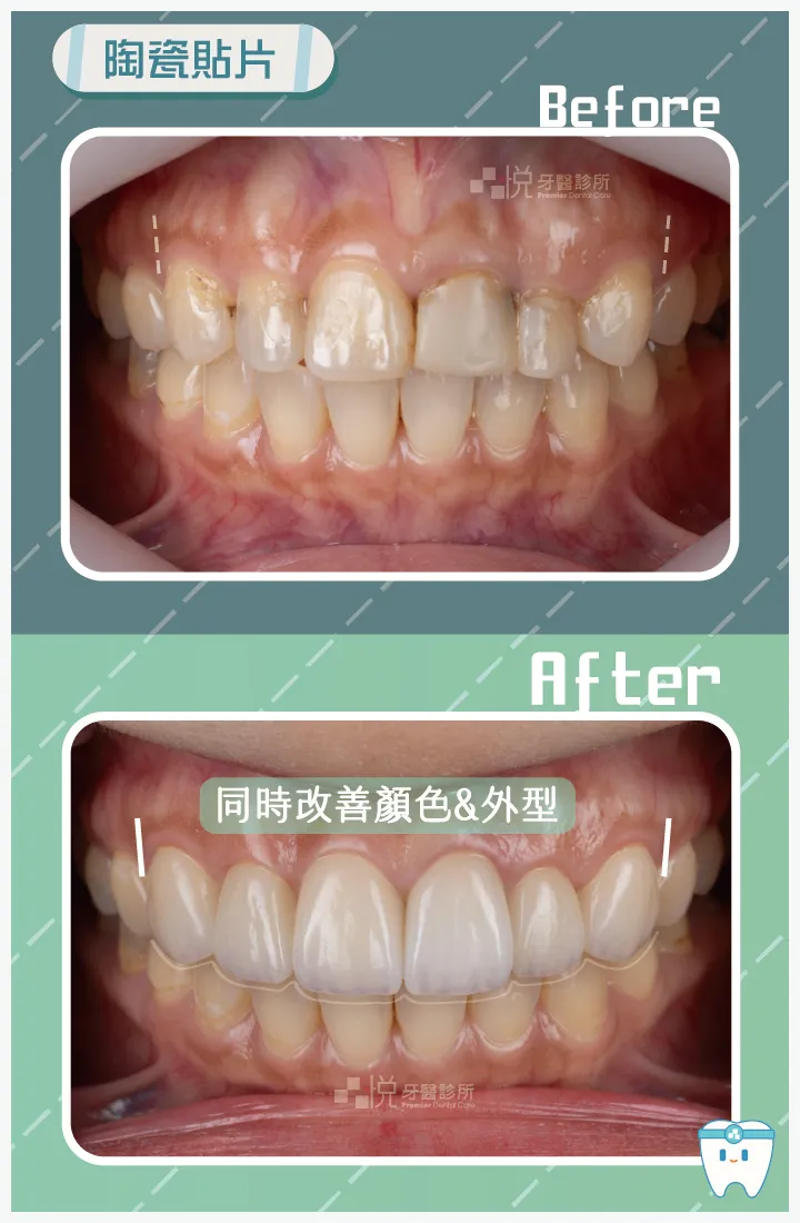 陶瓷貼片可同時改善牙齒顏色,並且些微調整牙齒排列。
案例提供:品悅牙醫 趙子睿醫師