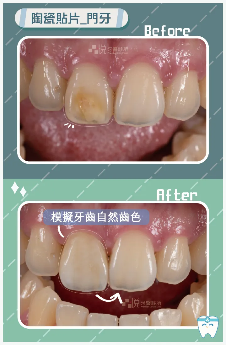 此為單顆右上正中門牙陶瓷貼片修復案例,可以看到陶瓷貼片盡可能複製左側門齒顏色與質地。,貼片製作時也須參考鄰牙顏色與形狀,才能在口中看起來非常自然。