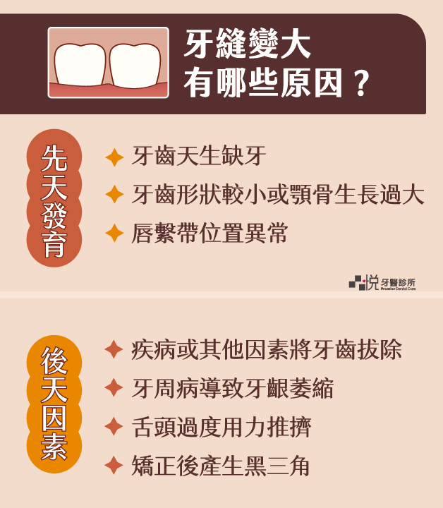 牙縫變大的原因分為先天後天:先天包含,天生缺牙、牙齒形狀、唇繫帶位置異常;後天包含,疾病、牙周病、舌頭過度用力、黑三角。