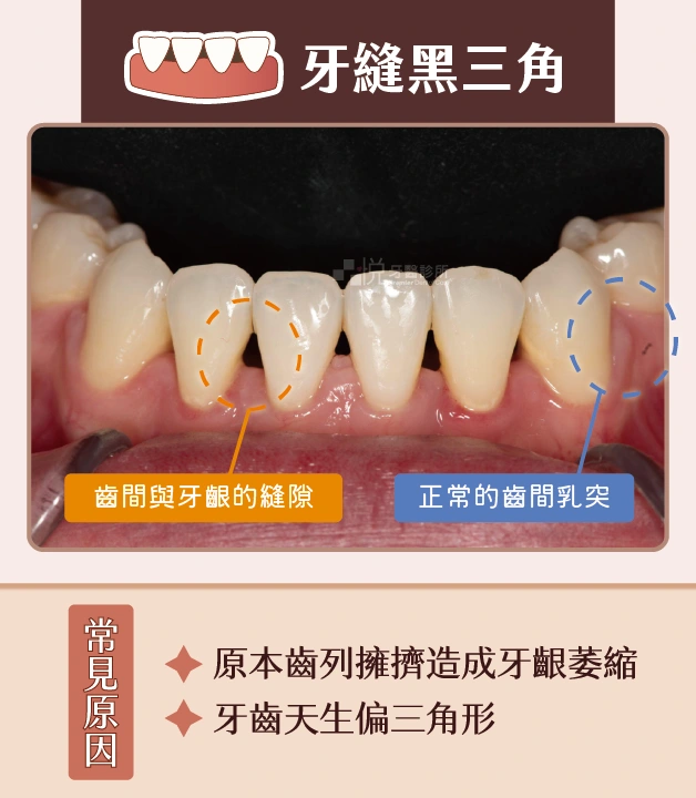 牙縫黑三角常見原因有原本齒列擁擠造成牙齦萎縮,或是牙齒天生偏三角形。