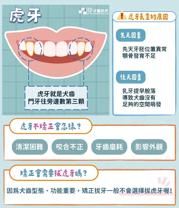 虎牙位置=犬齒,位置在門牙往旁邊數第三顆。矯正一般「不會」選擇拔虎牙,但虎牙沒有矯正會導致各種困難喔!