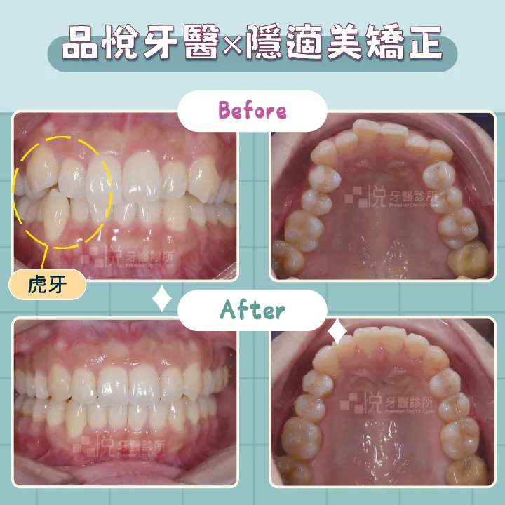 虎牙隱適美矯正案例。
案例提供:李慧凌醫師 品悅牙醫