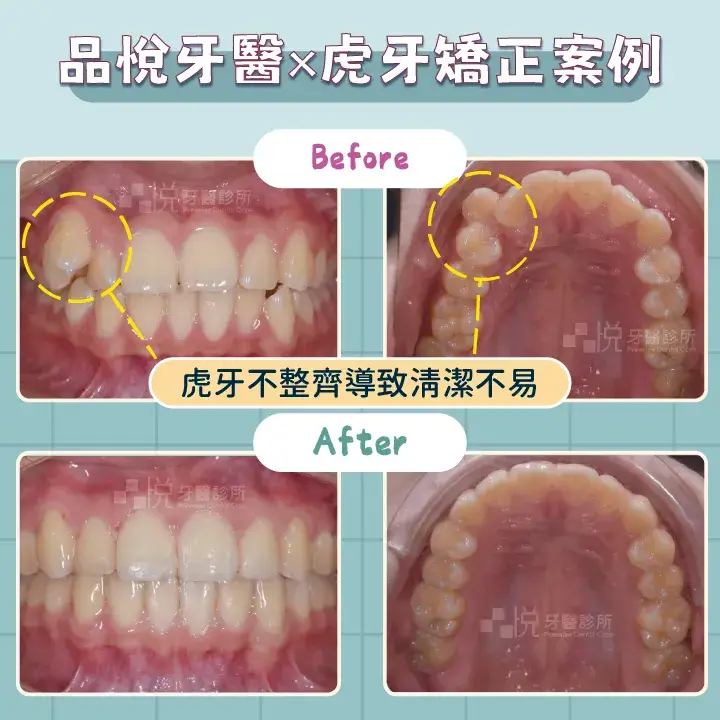 虎牙矯正案例。因為虎牙不整齊導致清潔不易。
案例提供:李慧凌醫師 品悅牙醫