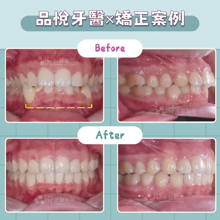 虎牙矯正案例。案例提供:李慧凌醫師 品悅牙醫