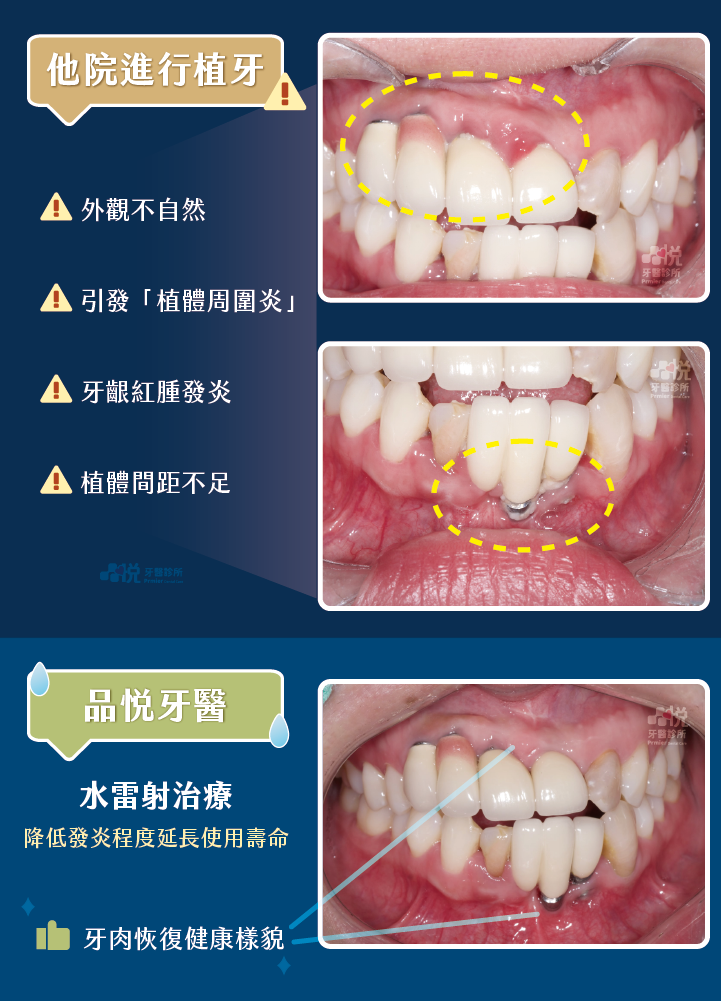 患者因他院植牙評估不完整導致後續許多問題,透過品悅牙醫 張志嘉醫師利用「水雷射治療」降低發炎程度並延長植牙使用壽命。
案例提供:張志嘉醫師 品悅牙醫
