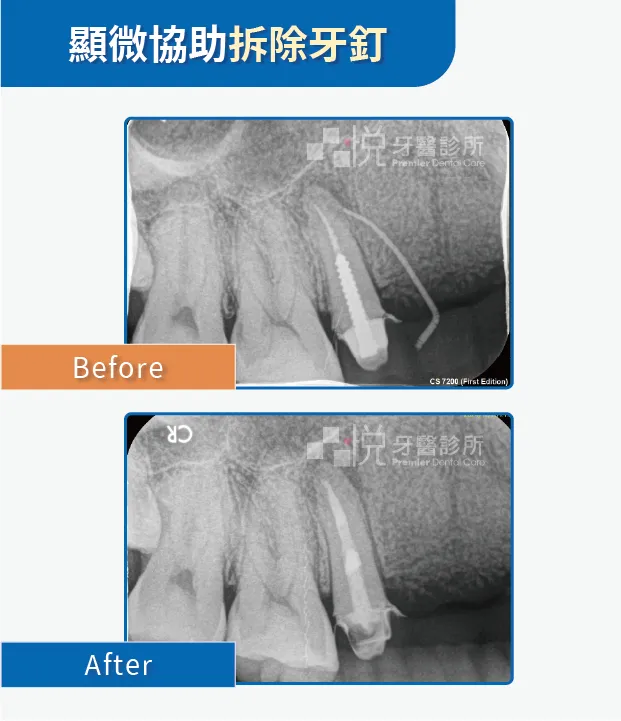 顯微鏡協助拆除牙釘案例提供:陳志恆醫師 品悅牙醫
