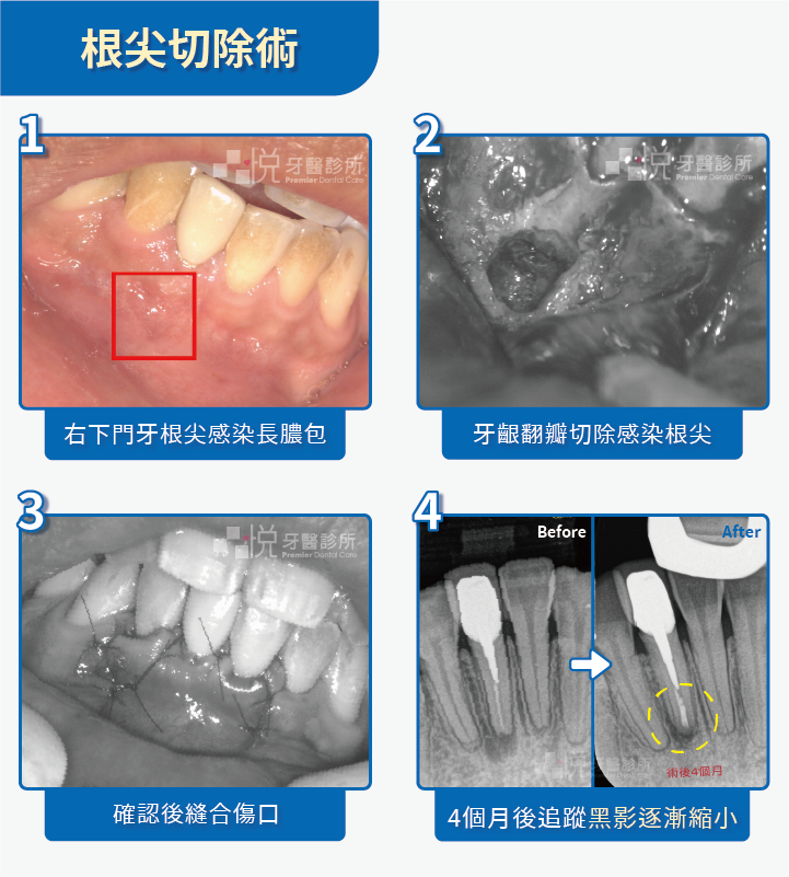 顯微鏡根尖切除術案例提供:陳志恆醫師 品悅牙醫