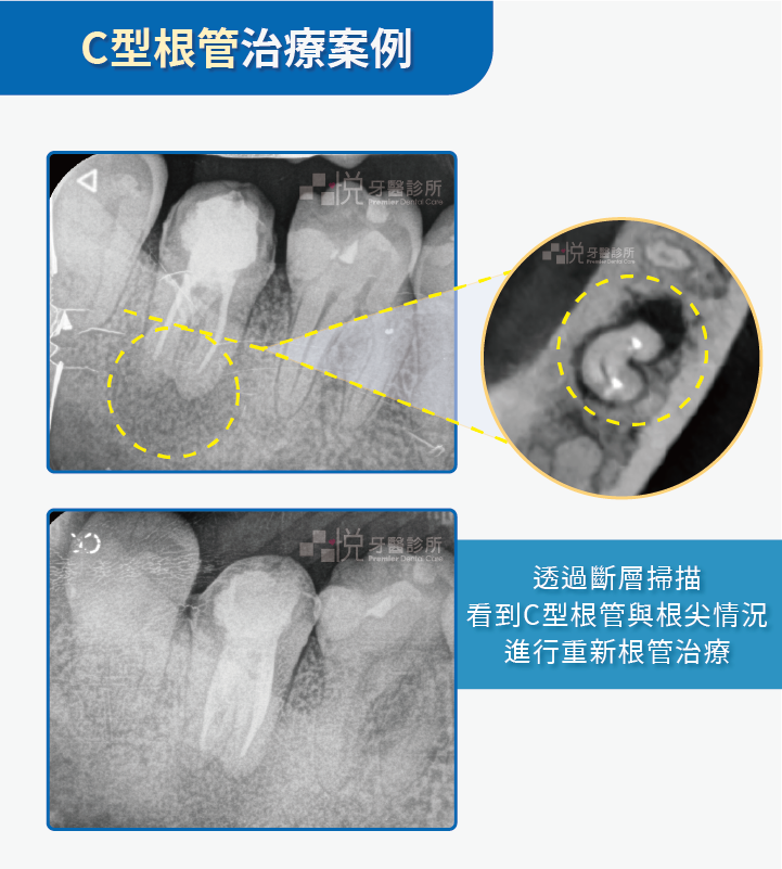 c型根管、案例提供:陳志恆醫師 品悅牙醫