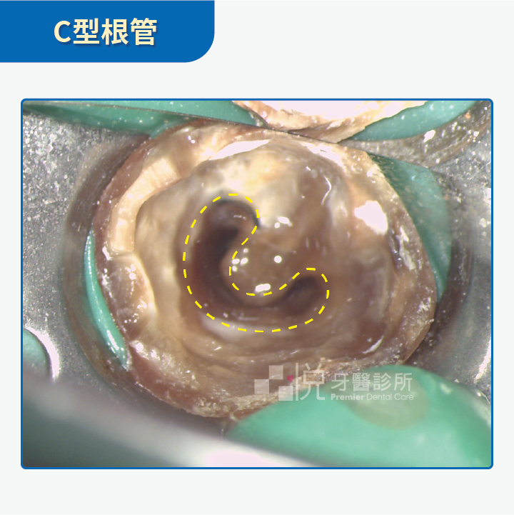 c型根管,案例提供:陳志恆醫師 品悅牙醫