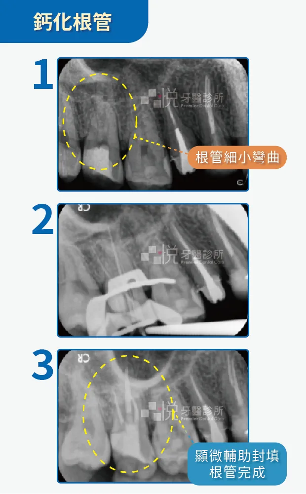 鈣化根管,案例提供:陳志恆醫師 品悅牙醫