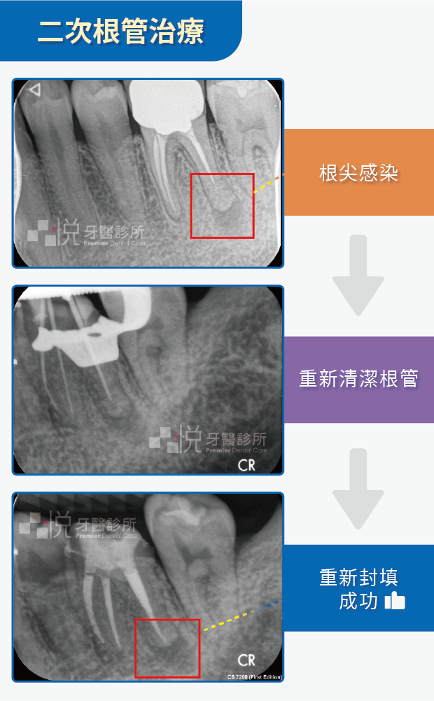 二次根管治療案例提供:陳志恆醫師 品悅牙醫