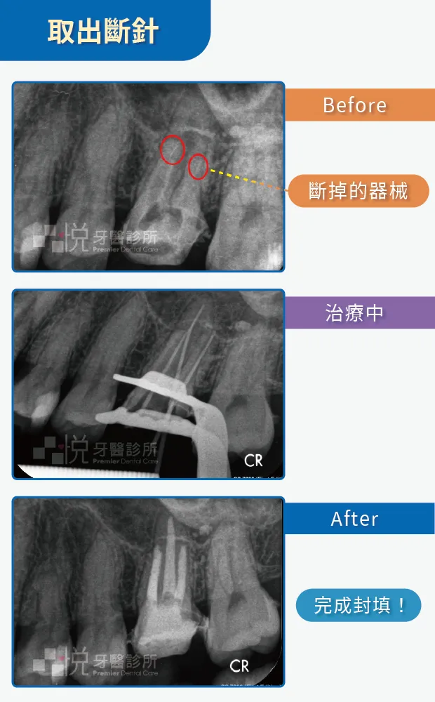 顯微鏡取出斷針案例提供:陳志恆醫師 品悅牙醫