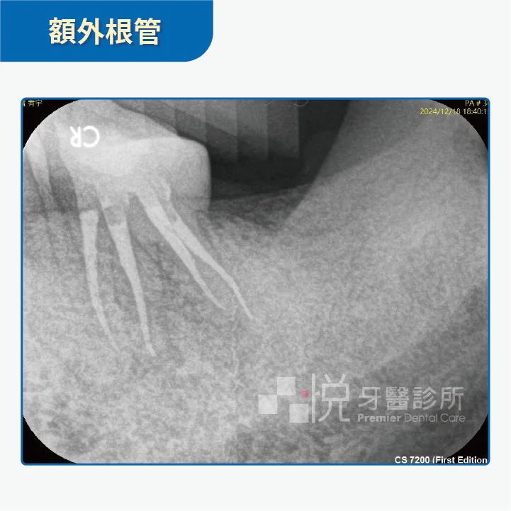 顯微鏡協助額外根管案例提供:陳志恆醫師 品悅牙醫