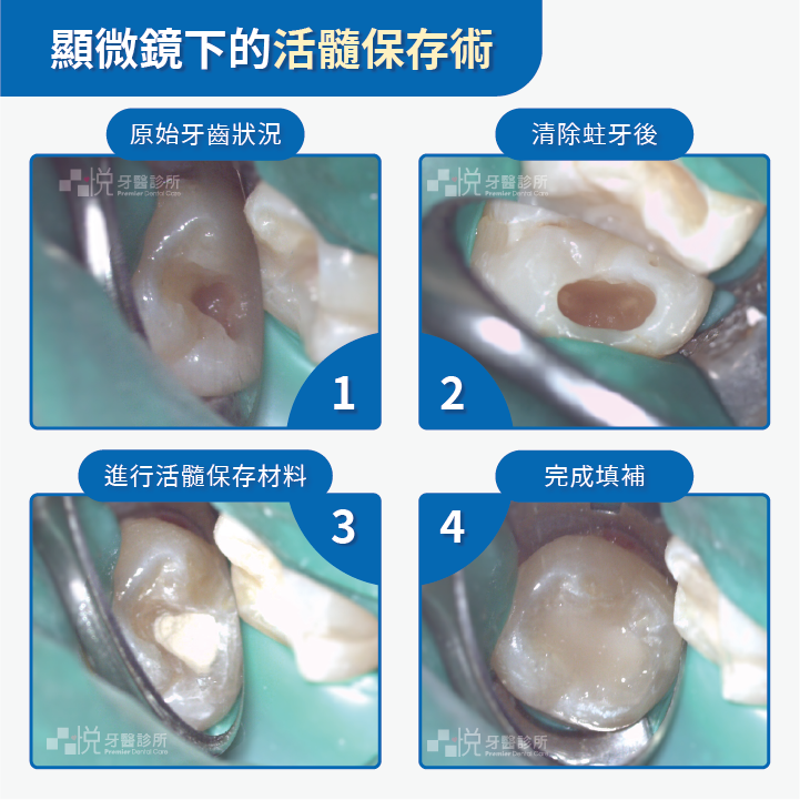 顯微鏡活髓保存術案例提供:陳志恆醫師 品悅牙醫
