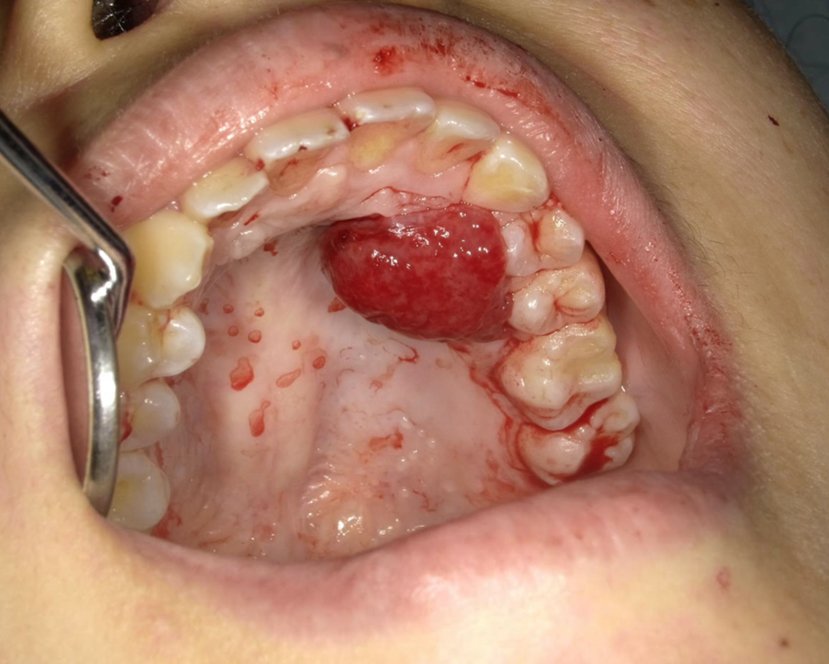 妊娠性牙齦瘤,圖片來源:Chigusa Y, Okuda R, Teratani Y, Matsuzaka S, Mandai M. Pregnancy Epulis. JMA J. 2023;6(2):206-208.