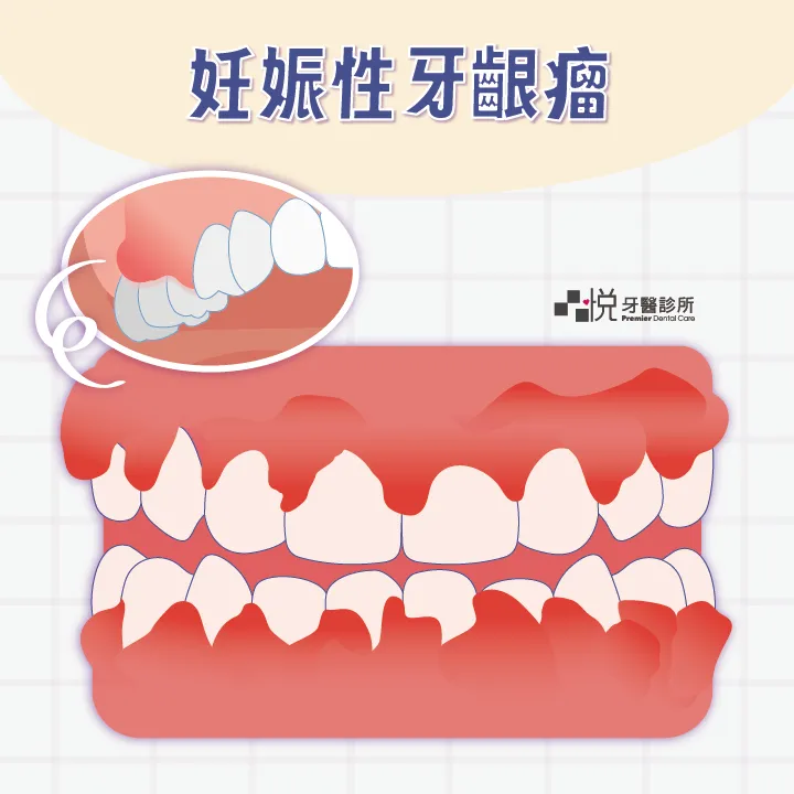 因為懷孕賀爾蒙變化,有可能會有「妊娠性牙齦瘤」。通常無害,但是還是建議到診所讓牙醫師檢查。