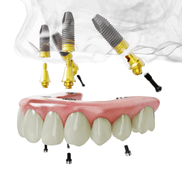 諾保科燦金植體all-on-4植牙