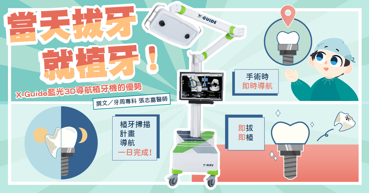 當天拔牙就植牙！搭配X-Guide藍光3D導航植牙機的優勢