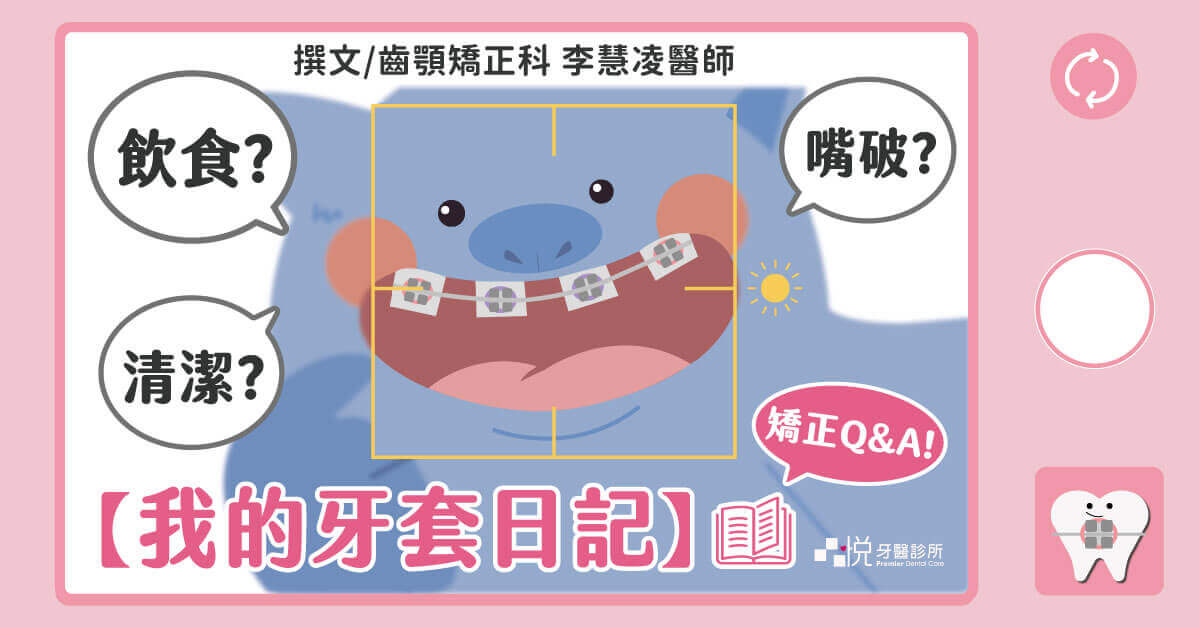 【我的牙套日記】牙齒矯正中想知道的飲食、清潔、嘴破小問答