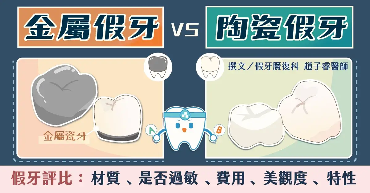 【金屬假牙VS陶瓷假牙】材質、特性、是否過敏、美觀度、費用