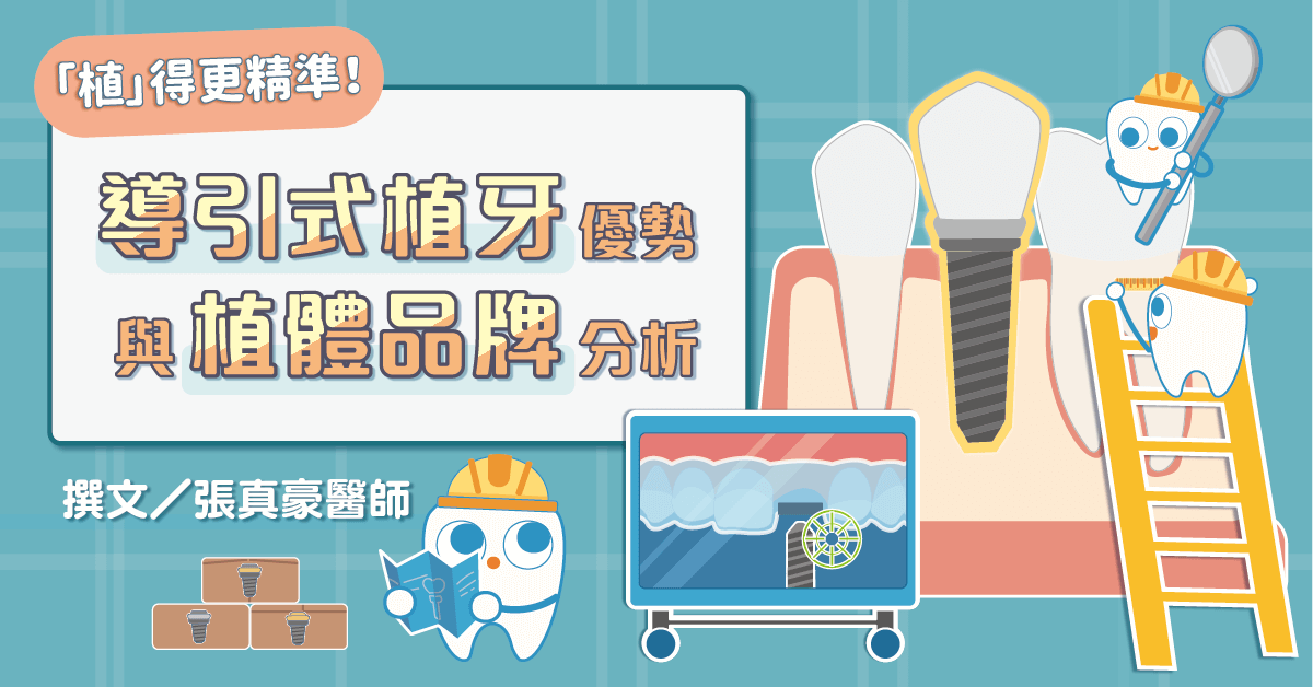 「植」得更精準！導引式植牙優勢與植牙植體品牌分析