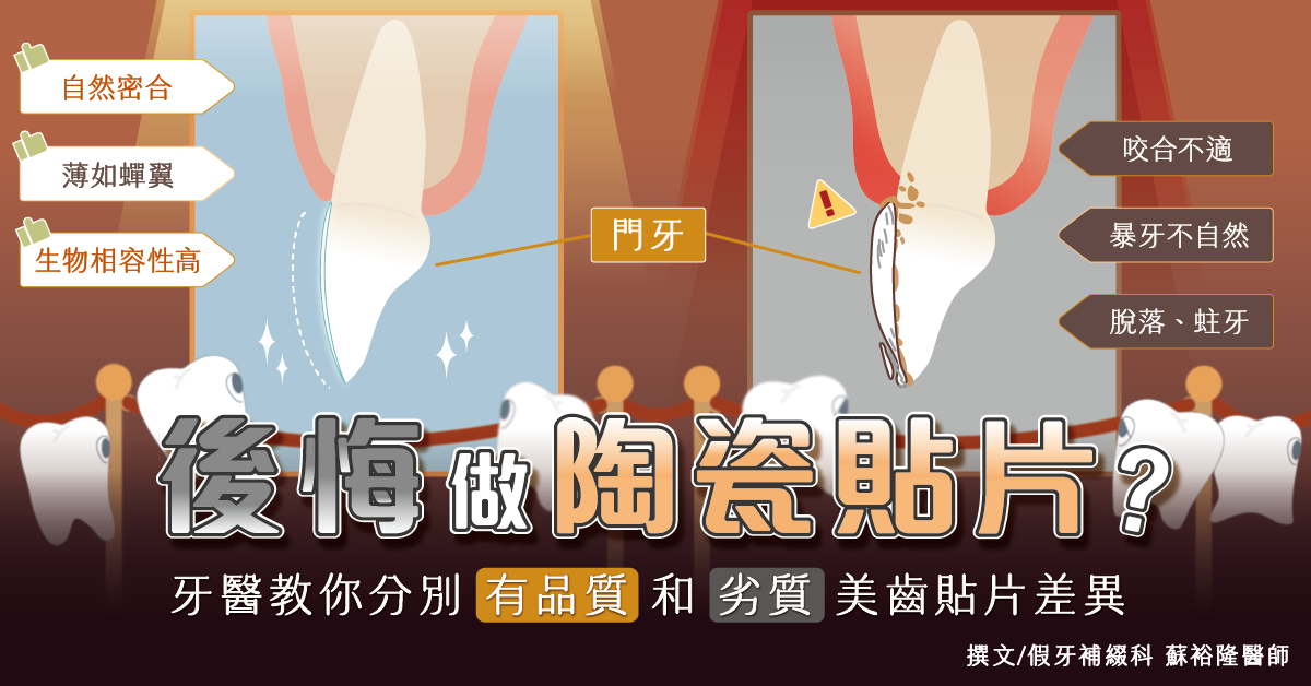 後悔做陶瓷貼片？牙醫教你分別有品質和劣質美齒貼片的差異