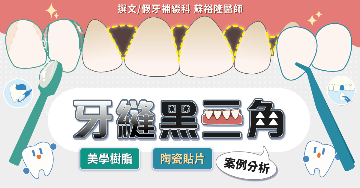 【矯正後黑三角縫】陶瓷貼片、美學樹脂改善牙縫黑三角案例分析