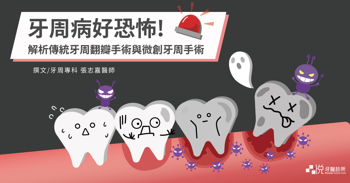 牙周病好恐怖！解析傳統牙周翻瓣手術與微創牙周手術