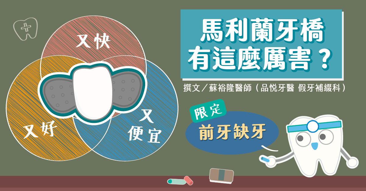 【前牙缺牙限定】馬利蘭牙橋更快更好更便宜？這種好牙橋哪裡找？