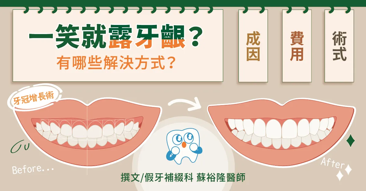 一笑就露牙齦？「牙冠增長術」費用、恢復期多久、照護須知、案例