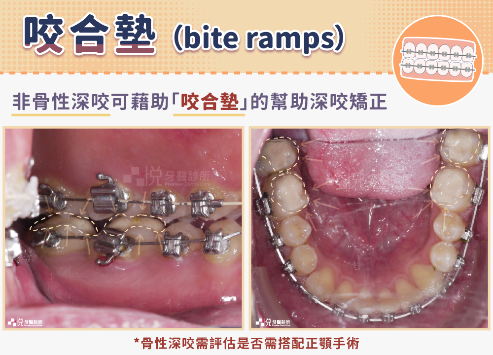 深咬矯正看這篇!牙醫剖析深咬成因影響、矯正方式比較、常見問答 - 品悅牙醫診所【新竹竹北牙醫推薦】