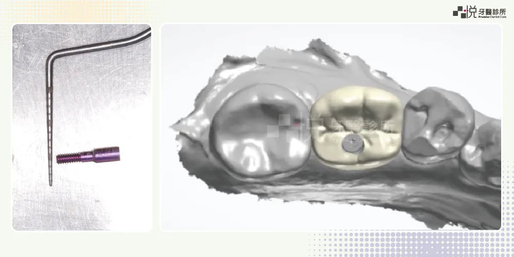 植牙假牙的固定螺絲，約只有1-2mm粗；植牙的咬合面常會故意設計的比旁邊的真牙稍窄一些
案例提供：饒庭伃 醫師 品悅牙醫
