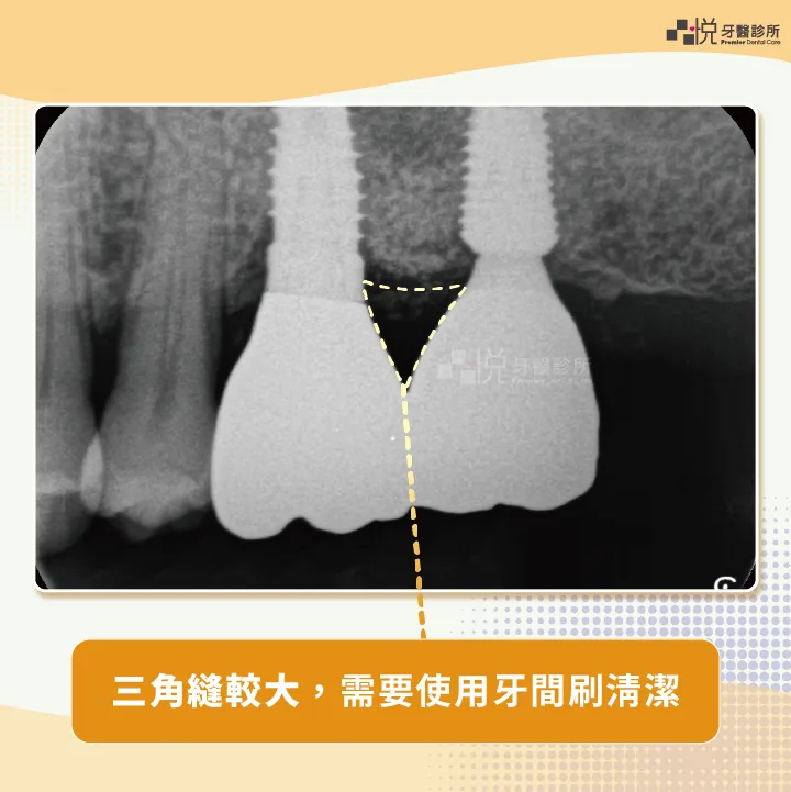 植牙間的三角縫，比真牙的三角縫來得大，需使用牙間刷清潔
案例提供：饒庭伃 醫師 品悅牙醫

