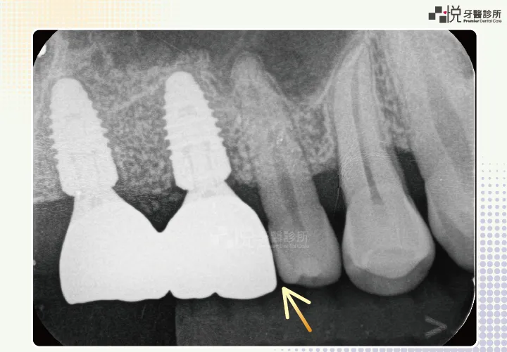 可以看到真牙和植牙之間，有一條很細的牙縫。可以靠植牙假牙燒瓷，或是於前方真牙的表面補樹脂解決。
案例提供：饒庭伃 醫師 品悅牙醫