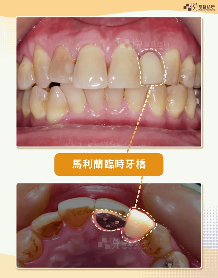 馬利蘭臨時假牙以一片很薄的金屬貼在隔壁牙齒上支撐
案例提供：饒庭伃醫師 品悅牙醫