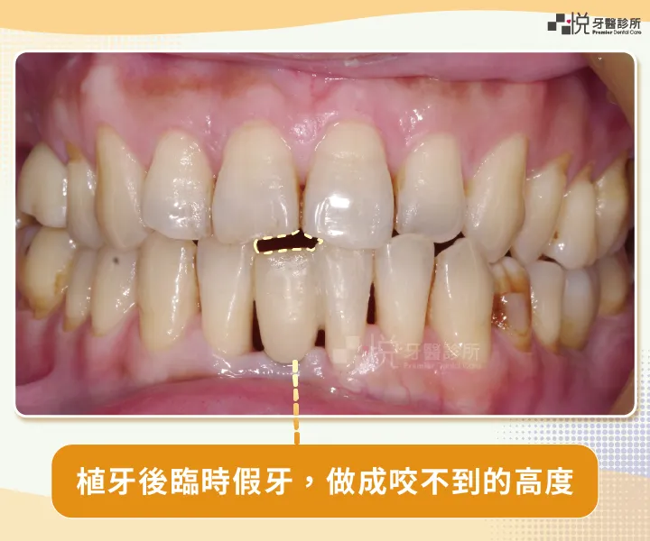 圖1：若植完牙就裝臨時假牙，臨時假牙會暫時做成咬不到的樣子
案例提供：饒庭伃醫師 品悅牙醫