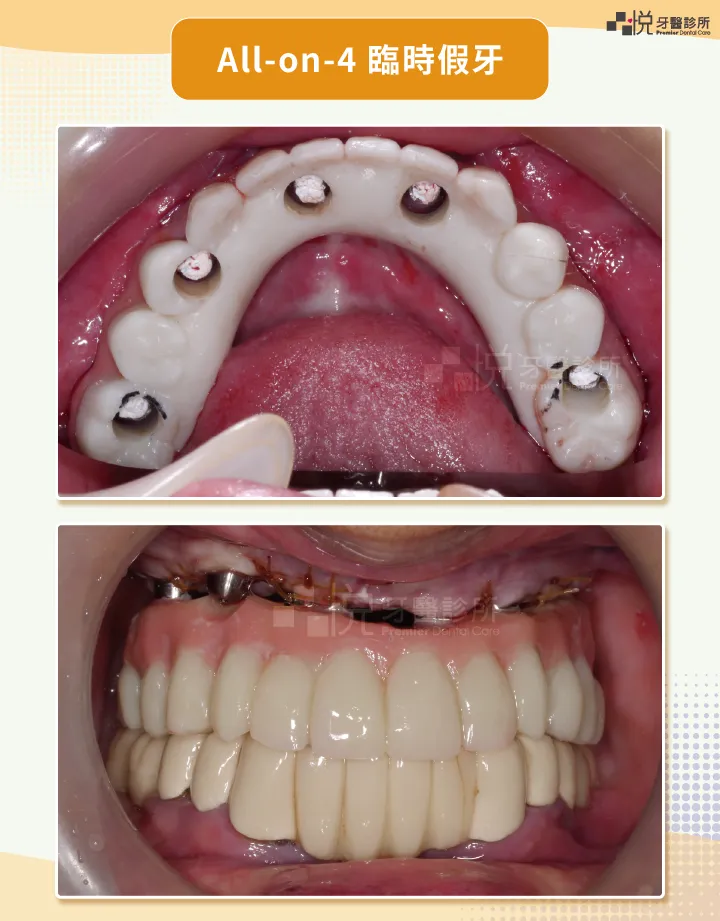 圖2：All-on-4 臨時假牙
案例提供：饒庭伃 醫師 品悅牙醫
