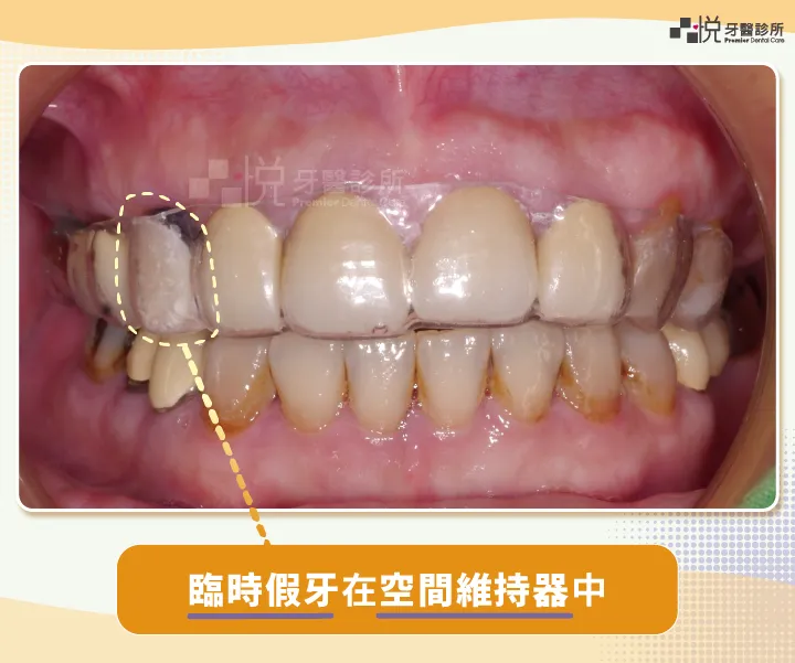 臨時假牙卡在維持器內，戴上時不但可以維持空間，還可兼顧美觀。
案例提供：饒庭伃醫師 品悅牙醫